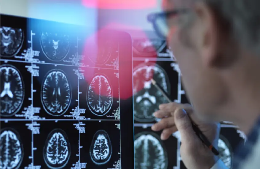 أسئلة بسيطة لمعرفة العلامات المبكرة لألزهايمر